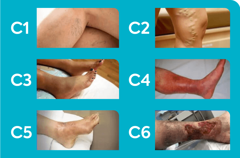 enfermedades-vasculares-piernas.png